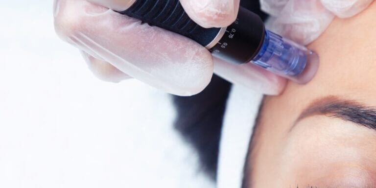 Female client with eyes closed receiving microneedling treatment. Services provided by Fabulously Beautiful, Sutton Valence, Kent